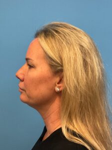 Facial-Fat-Grafting-Case--1028 | Before Facial Fat Grafting 2