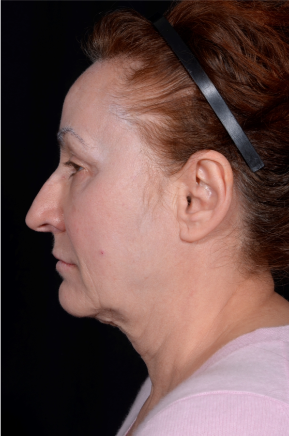 Face-and-Neck-Lift-Case--8423 | Before Facelift 2