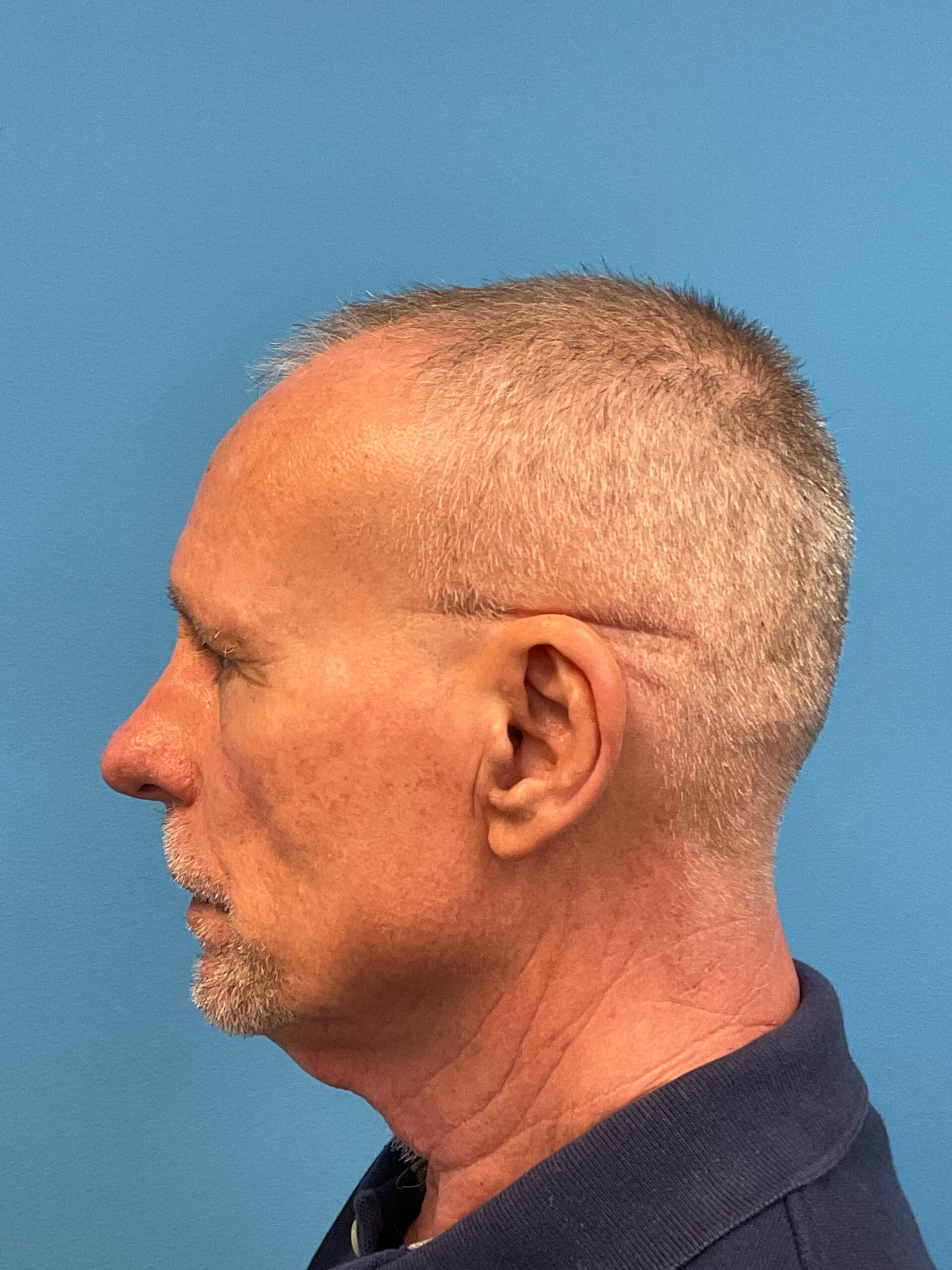 Facelift-Case--7592 | Before Facelift 2