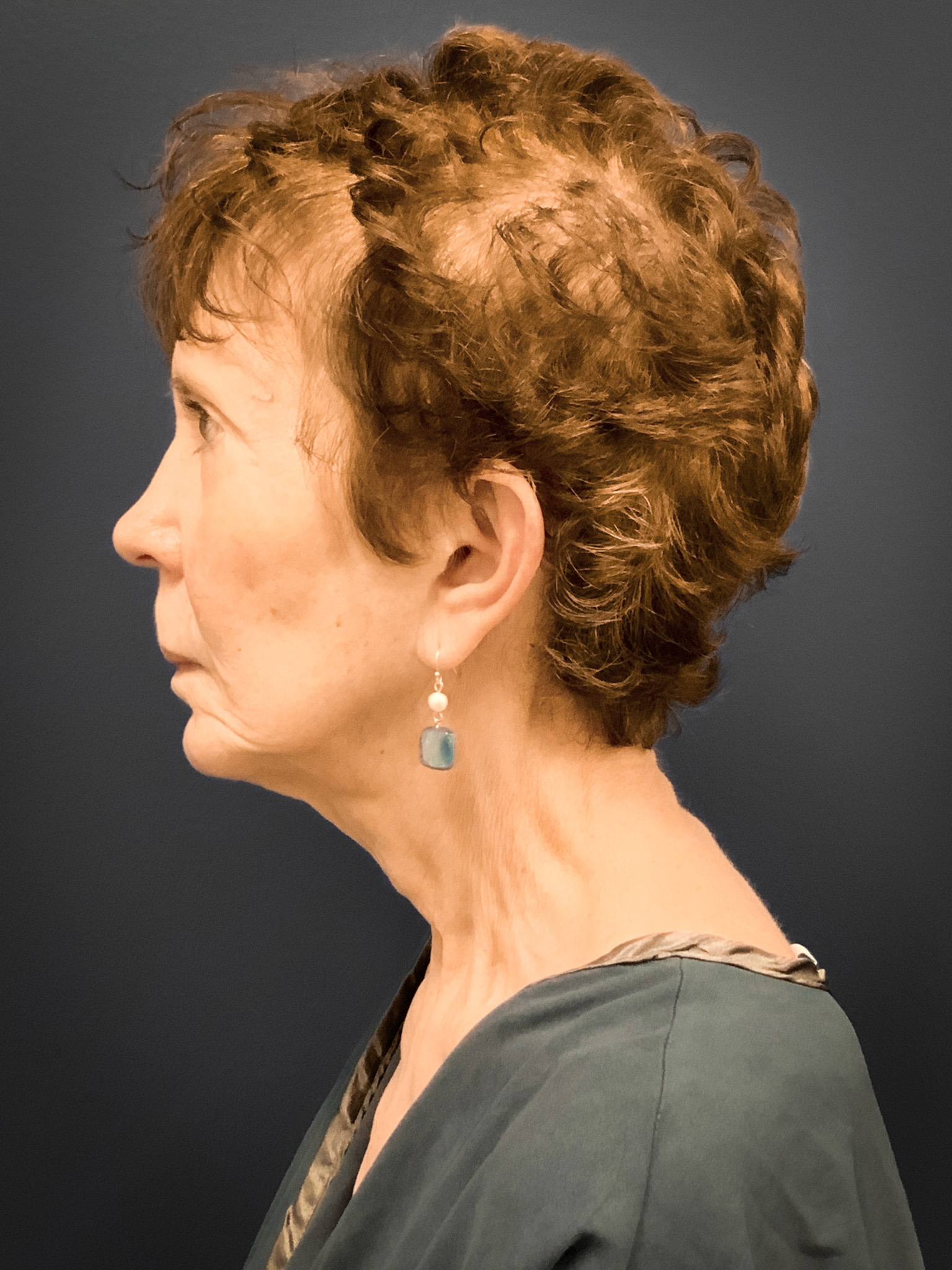 Facelift-Case--8727 | Before Facelift 2