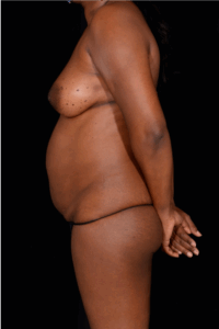 Abdominoplasty-Case--6650 | Before Liposuction 2