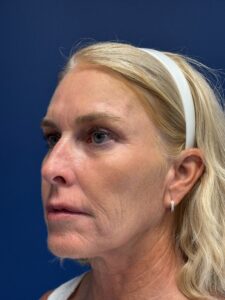 Facelift-Case--2253 | Before Facelift 2