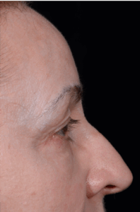 Blepharoplasty-Case--9685 | Before Eyelid Surgery 2