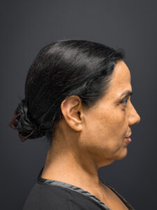 Facial-Fat-Grafting-Case--8416 | Before Facial Fat Grafting 2