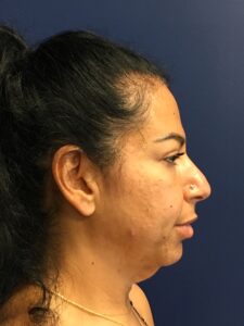 Facelift-Case--8534 | Before Facelift 2