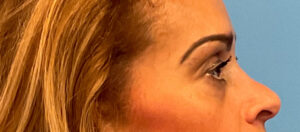 Quad-Blepharoplasty-Case--1261 | Before Dr. Arjun Kanuri 2