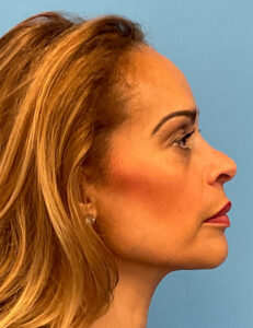 Facial-Fat-Grafting-Case--4152 | Before Facial Fat Grafting 2