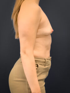 Breast-Augmentation-Case--2225 | Before Dr. Arjun Kanuri 2