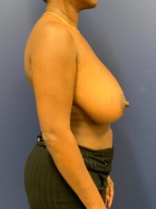 Breast-Reduction-Case--9689 | Before Breast Reduction 2