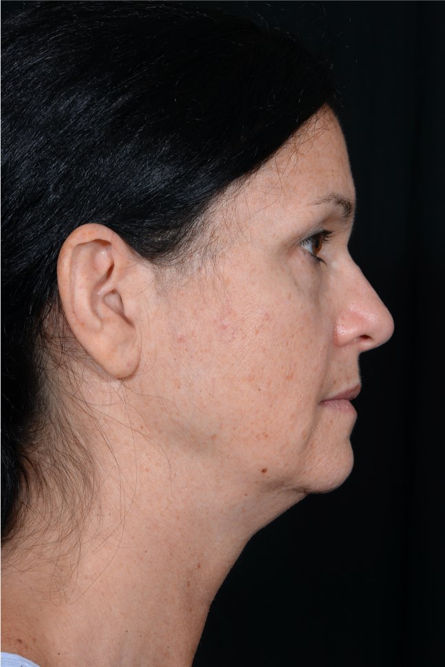 Face-and-Neck-Lift-Case--9403 | Before Facelift 2