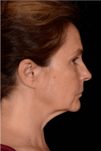 Facelift-Case--4160 | Before Facelift 2