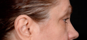 Quad-Blepharoplasty-Case--1851 | Before Dr. Arjun Kanuri 1