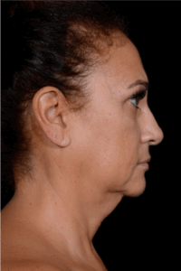 Rhinoplasty-Case--8713 | Before Rhinoplasty 2