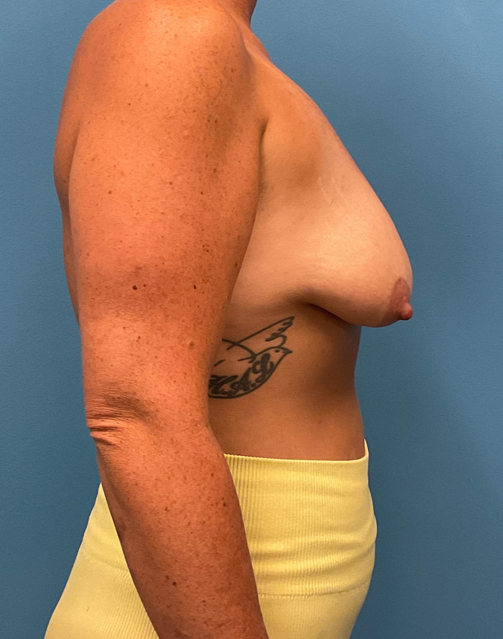 Augmentation-Mastopexy-Case--6658 | Before Breast Augmentation With Lift 2