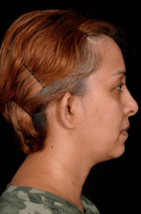 Otoplasty-Case--4655 | Before Otoplasty 2