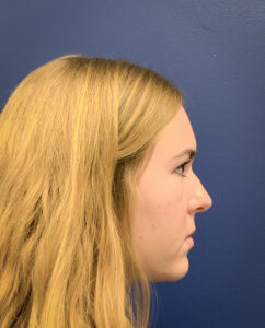 Rhinoplasty-Case--6484 | Before Rhinoplasty 2