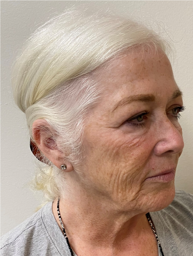 Face-and-Neck-Case--1975 | Before Facelift 2