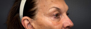 Upper-Blepharoplasty-Case--2075 | Before Dr. Arjun Kanuri 2