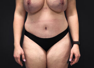 Abdominoplasty-Liposuction-Flanks-Case--6546 | After Liposuction 1