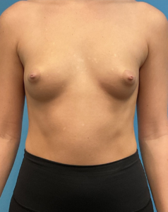 Breast-Augmentation-Case--28179 | Before Dr. Arjun Kanuri 1