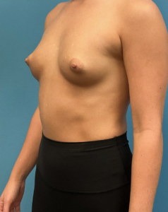Breast-Augmentation-Case--28179 | Before Dr. Arjun Kanuri 2