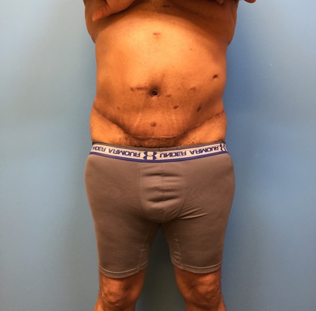 Front view of patient after undergoing a body lift procedure