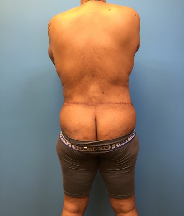 Rearview profile of patient after undergoing a body lift procedure