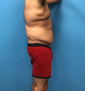 Side profile of patient before undergoing a body lift procedure