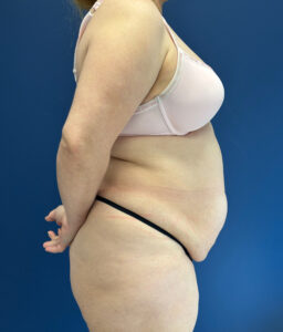 Abdominoplasty-Case--1259 | Before Tummy Tuck 2