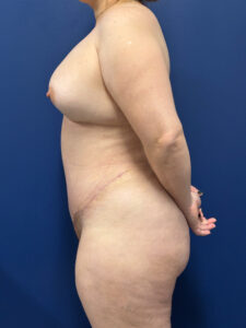 Brazilian-Butt-Lift-Case--9569 | After Brazilian Butt Lift 2