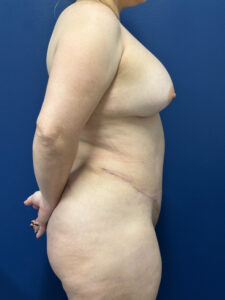 Abdominoplasty-Case--1259 | After Tummy Tuck 2