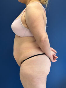 Brazilian-Butt-Lift-Case--9569 | Before Brazilian Butt Lift 2