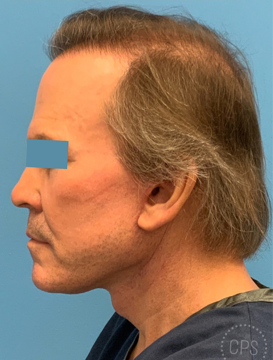 Men-Neck-Face-Lift-Case--23753 | After Facelift 1