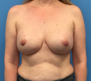 Breast-Reconstruction-Case--295 | After Breast Reconstruction 1