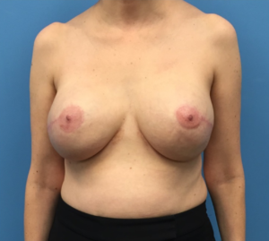 Breast-Reconstruction-Case--296 | After Breast Reconstruction 1