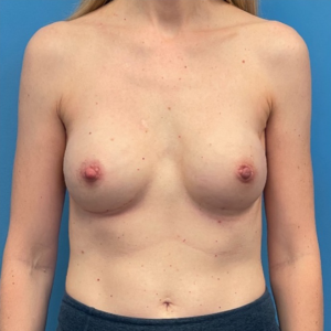Breast-Reconstruction-Case--298 | After Breast Reconstruction 1