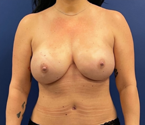 Breast-Reconstruction-Case--306 | After Breast Reconstruction 1