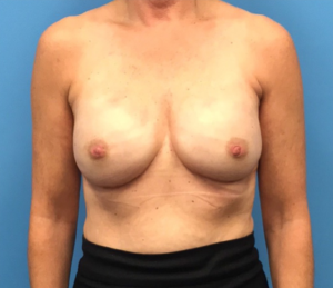 Breast-Reconstruction-Case--310 | After Breast Reconstruction 1