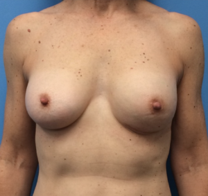 Breast-Reconstruction-Case--312 | After Breast Reconstruction 1
