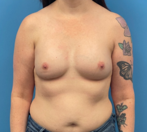 Breast-Reconstruction-Case--335 | After Breast Reconstruction 1