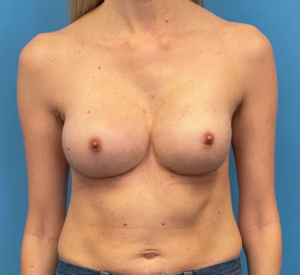 Case--317 | After Breast Reconstruction 1