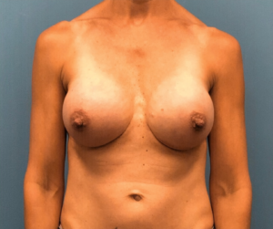 Case--318 | After Breast Reconstruction 1