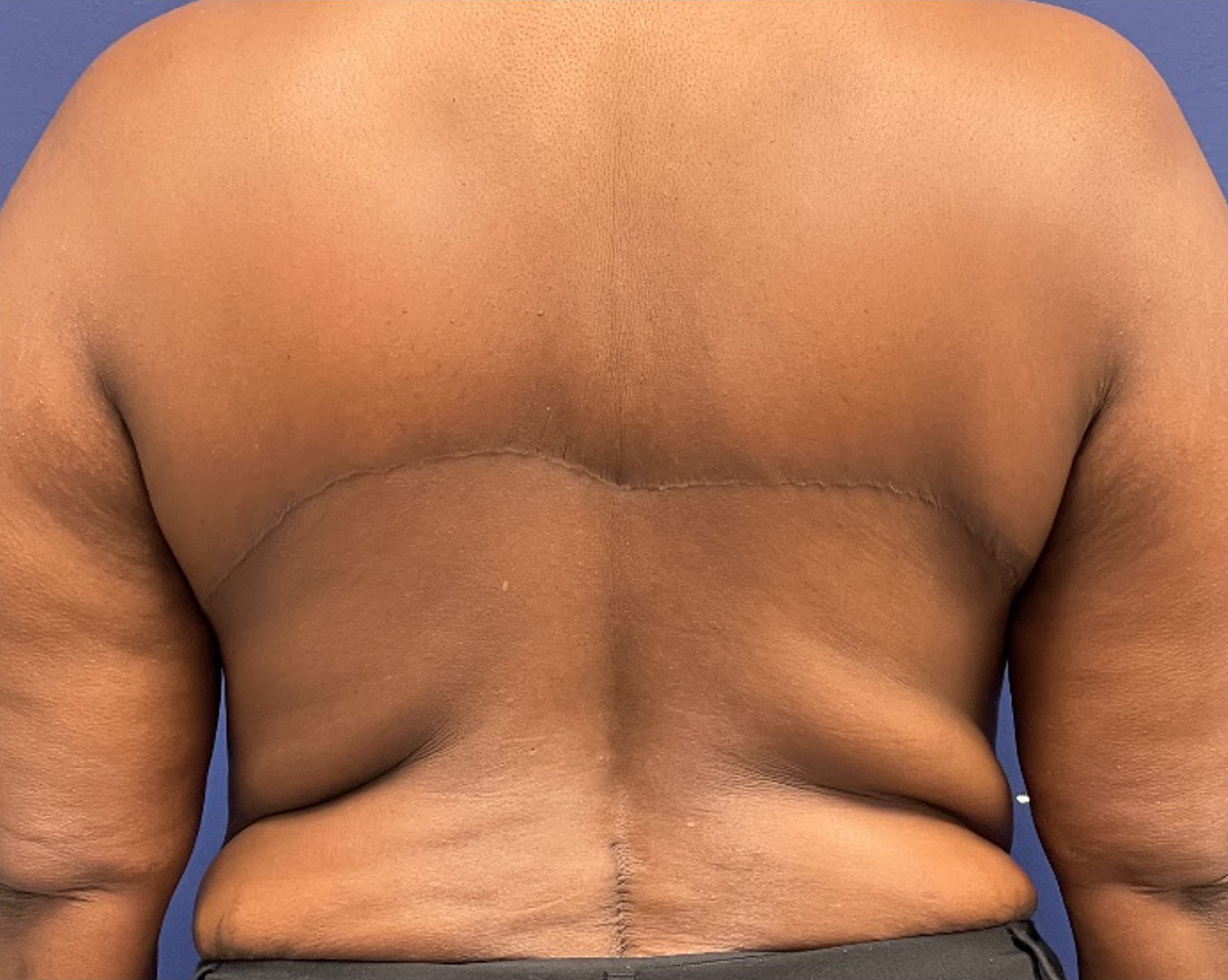 Body-Lift-Case--275 | After Body Lift 1