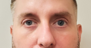 Lower-Blepharoplasty-Case--359 | After Dr. Arjun Kanuri 2