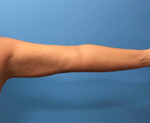 Liposuction-Case--72-2 | After Liposuction 1