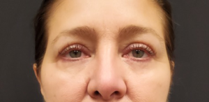 Quad-Blepharoplasty-Case--358 | After Dr. Arjun Kanuri 2