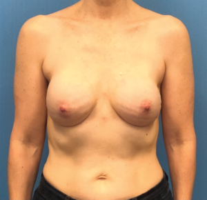Case--301 | After Breast Reconstruction 1