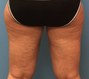 Case--278 | After Liposuction 2