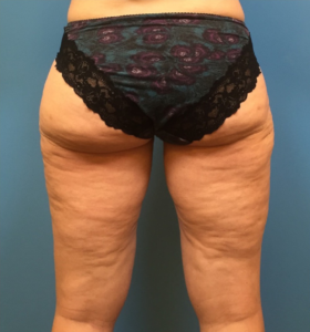 Case--281 | After Liposuction 2