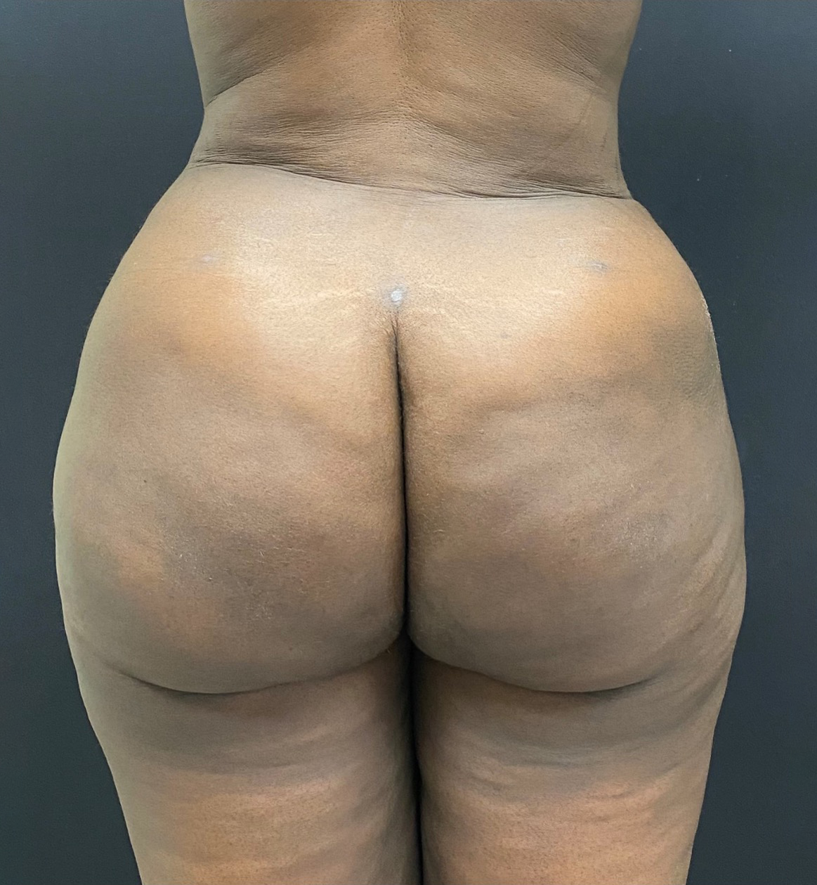 Brazilian-Butt-Lift-Case--353 | After Brazilian Butt Lift 1
